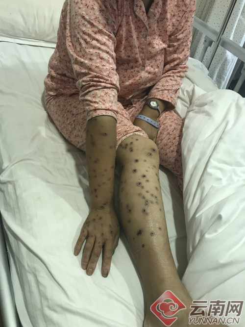 患者在博亚医院接受治疗18天后,毒伤口仍触目惊心